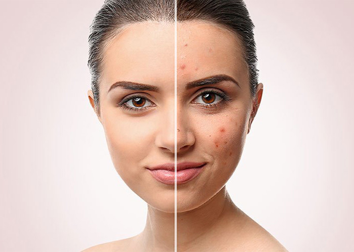 How to remove dark spots on face