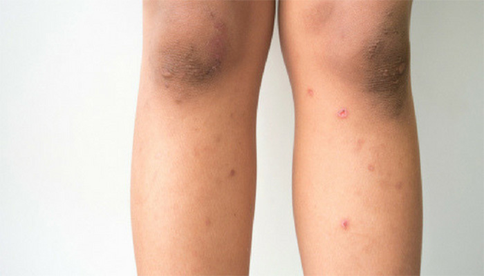 Dark spots on legs